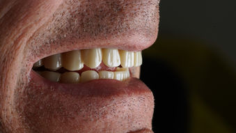 Transformer le désastre en santé avec l' implant cortico basal