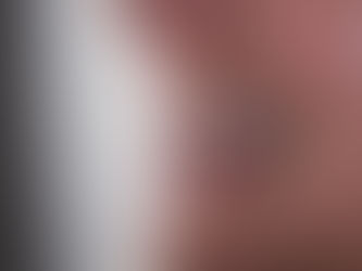 Nouvelle denture fixe avec l' implant cortico basal après un kyste et résection osseuse 