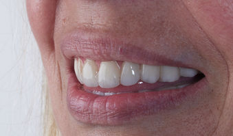 Choisir le bon implant dentaire en cas de maladie parodontale