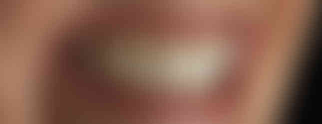 pose-implant-cortical