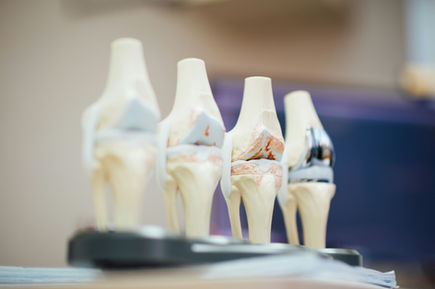 Four anatomical knee joint models on a table, showing different stages of degeneration. Soft focus background, neutral colors.