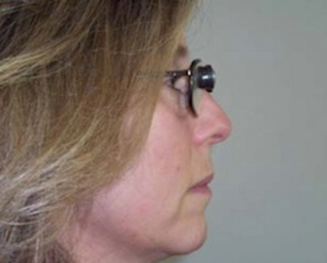 Image of female looking through scope of bioptic