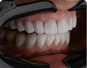 Professional Teeth Whitening vs. At-Home Whitening