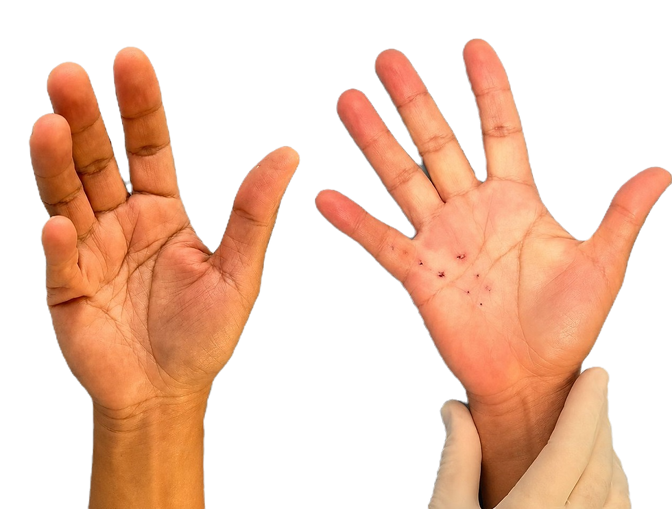 cirurgia para doença de dupuytren