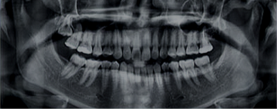 Radiologia odontológica 100% digital. Raiox Panorâmico,tomografia cone beam, periapicais interproximais e documentação odontologica