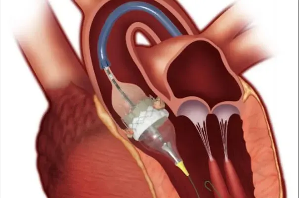 Severe aortic stenosis can be life-threatening, even without symptoms. Learn how early treatment with TAVR can reduce risks, improve long-term outcomes, and protect your heart health.