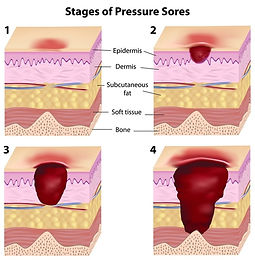 Pressure Sores: What are they and how do they effect you?