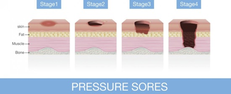 Stages of Pressure Sores