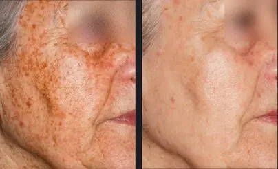 Transform your skin with IPL skin rejuvenation, the solution for pigmentation issues. Say farewell to unwanted dark spots and uneven skin tone, and embrace a brighter, more youthful complexion. Discover the magic of IPL for pigmentation correction today.