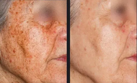 Transform your skin with IPL skin rejuvenation, the solution for pigmentation issues. Say farewell to unwanted dark spots and uneven skin tone, and embrace a brighter, more youthful complexion. Discover the magic of IPL for pigmentation correction today.