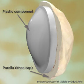 Patella component