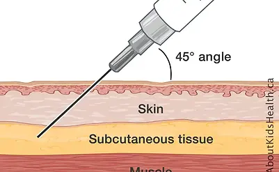 subcutaneous_injection_training_Ireland.webp