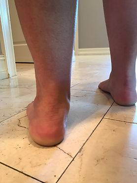 Orthotic fitting photo pronation