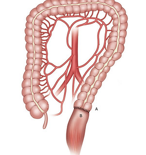 hartman reversal_edited_edited_edited.jp
