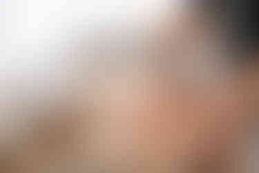 fire cupping on back with marks