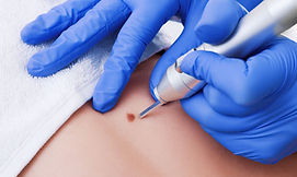 Técnica segura para remover lesiones cutáneas benignas como verrugas, lunares y fibromas de forma rápida y precisa.