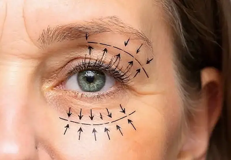Diagramatic representation of eyelid surgery