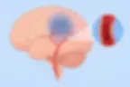 Diagramatic representation of a transient ischaemic attack of the human brain