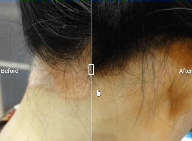 AROMASE-psoriasis-shampoo-review.gif