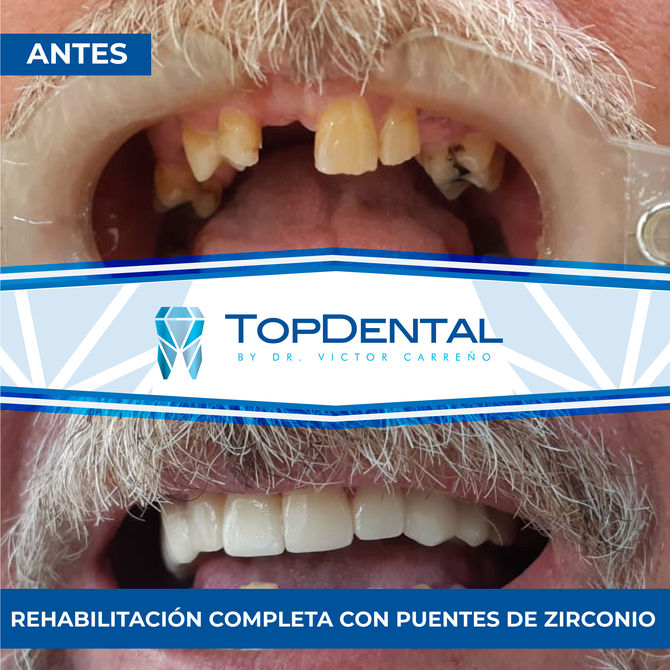 Coronas y Puentes de Zirconio