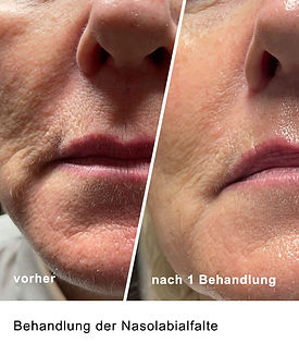 vorher-nachher-faden-3.jpg