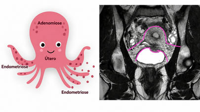 Ilustração anatômica da pelve feminina em matéria sobre a Teoria do Polvo, modelo usado para explicar dores associadas à endometriose.