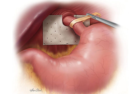 Biodesign Hiatal Hernia Graft.jpg