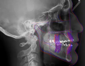 planmeca-romexis-cephalometric-analysis-superimpositions.webp