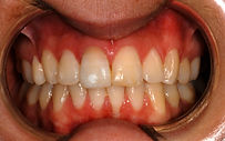 Teeth Whitening