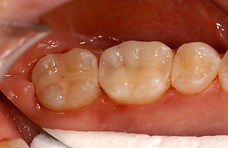 Metal Free (Non-Amalgam) Dentistry