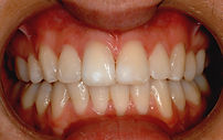 Tooth Whitening