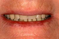 Swinglock Denture