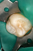 Minimal Intervention Dentistry