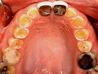 Dental Erosion