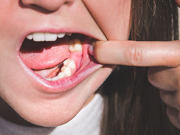 Socket Graft site