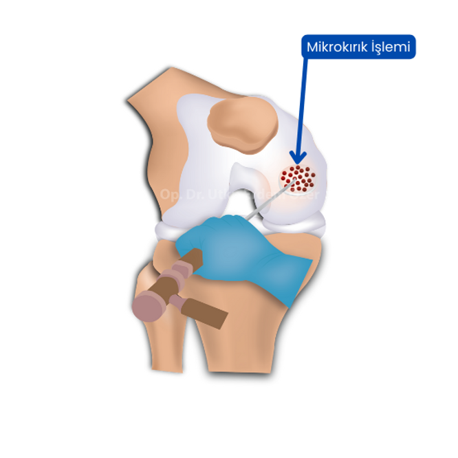 How long does it take for a microfracture in the knee to heal?