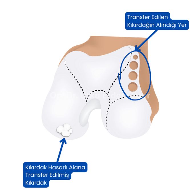 knee cartilage wear treatment