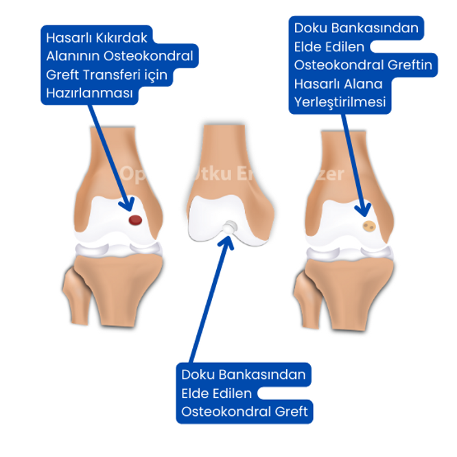 Osteochondral Allograft Transplantation