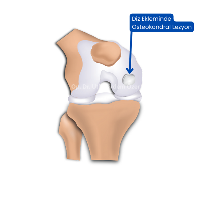 Surgery to Fix a Cartilage Piece in the Knee