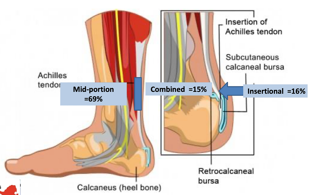 anatomical illustration highlighting achilles tendon pain site