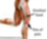 Anatomical drawing of a leg showing the site pain on the leg and the iliotibial band