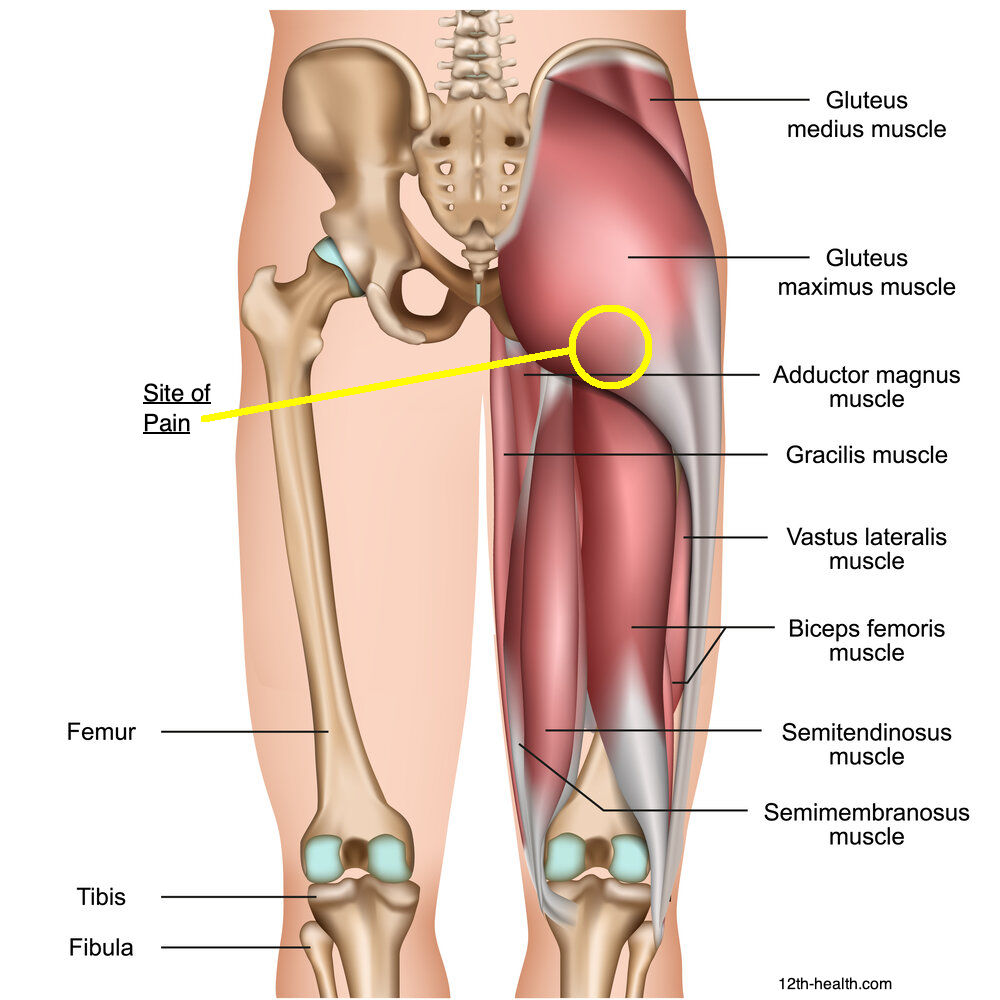 Upper Hamstring Pain