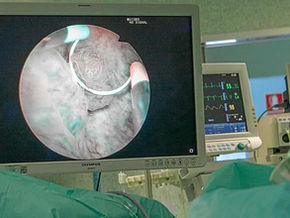 Diez personas son diagnosticadas por día con cáncer de vejiga en Argentina