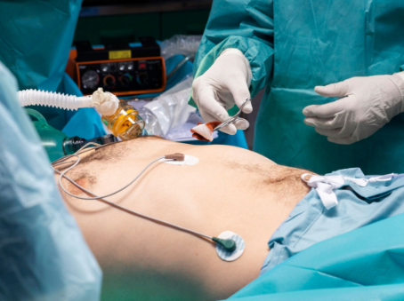 Intestino Perfurado Durante Cirurgia