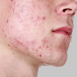 acne skin, boy with acne