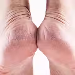 Skin-Concern-Cracked-Heels_1f1ca7c5-ce68-4865-902e-d0610c347528.avif