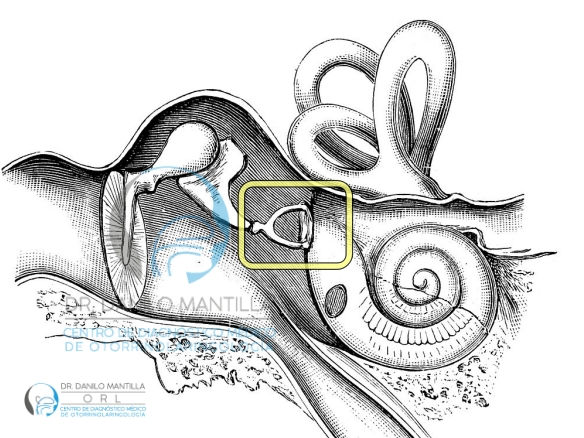 Ilustración médica en blanco y negro del oído medio e interno, con un recuadro amarillo resaltando el estribo (huesecillo del oído) donde se produce la otoesclerosis; fondo blanco y logo Dr. Danilo Mantilla Cirujano de Oído