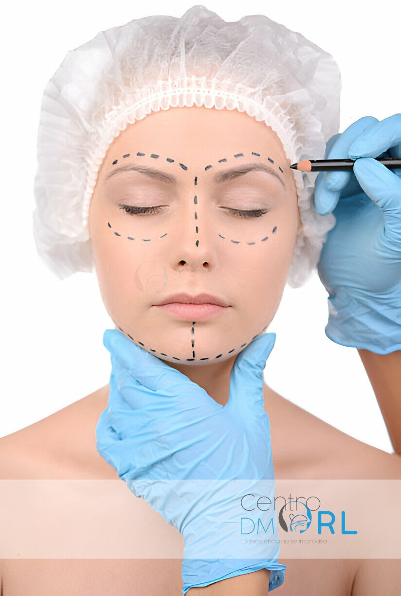 Marcaje prequirúrgico facial para cirugía estética
