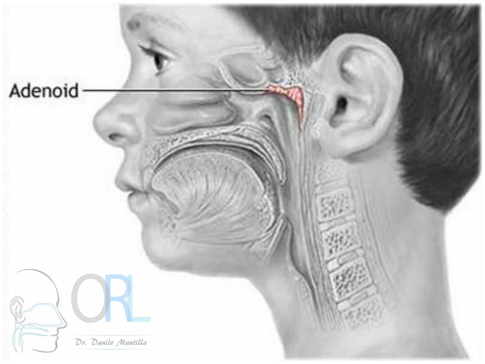 Adenoamigdalectomía Adenoidectomía Amigdalectomía