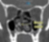 TomografĆa con un desvĆo del tabique nasal